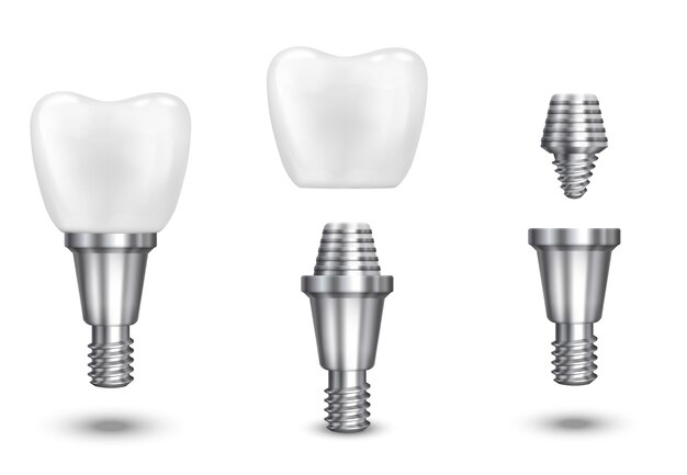 Implante dentário. Implante dentário e dente saudável, implante saudável, ilustração vetorial