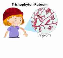 Vetor grátis infecção fúngica por trichophyton rubrum