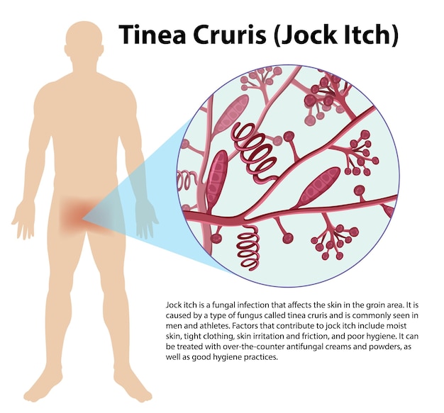 Vetor grátis infecção fúngica por trichophyton rubrum