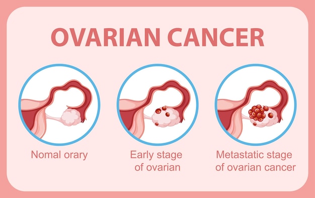 Vetor grátis infográfico de câncer de ovário infográfico