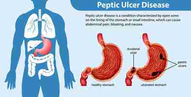 Vetor grátis infográfico de doença de úlcera péptica