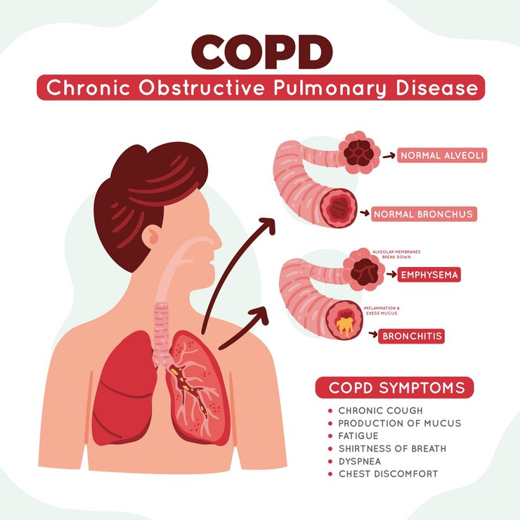 Vetor grátis infográfico de doença pulmonar obstrutiva crônica desenhado à mão