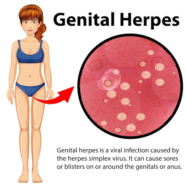 Infográfico de herpes genital com explicação