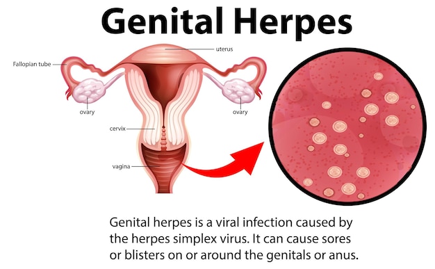 Vetor grátis infográfico de herpes genital com explicação