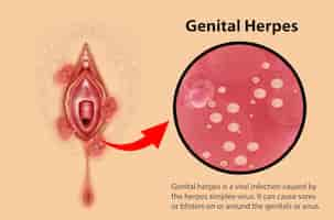 Vetor grátis infográfico de herpes genital com explicação