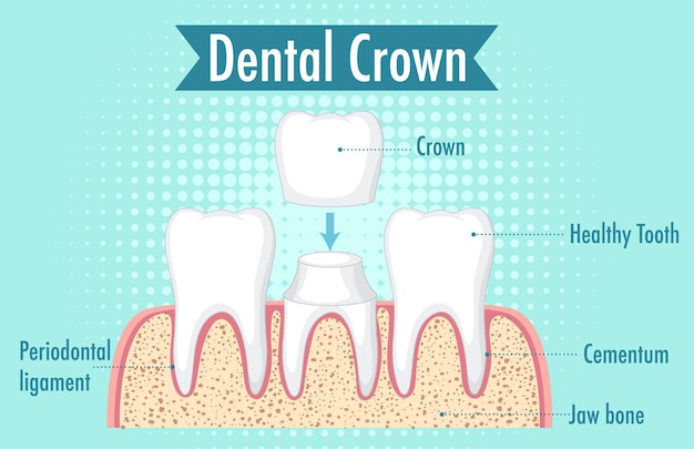 Infográfico de humano na coroa dentária