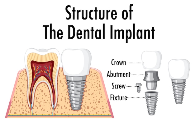 Infográfico de humano na estrutura do implante dentário