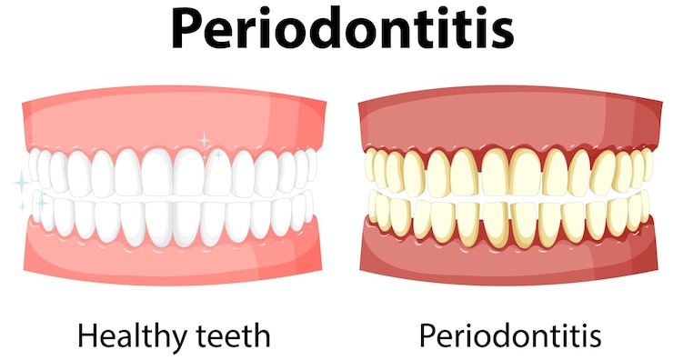 Vetor grátis infográfico de humanos em periodontite