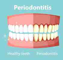 Vetor grátis infográfico de humanos em periodontite
