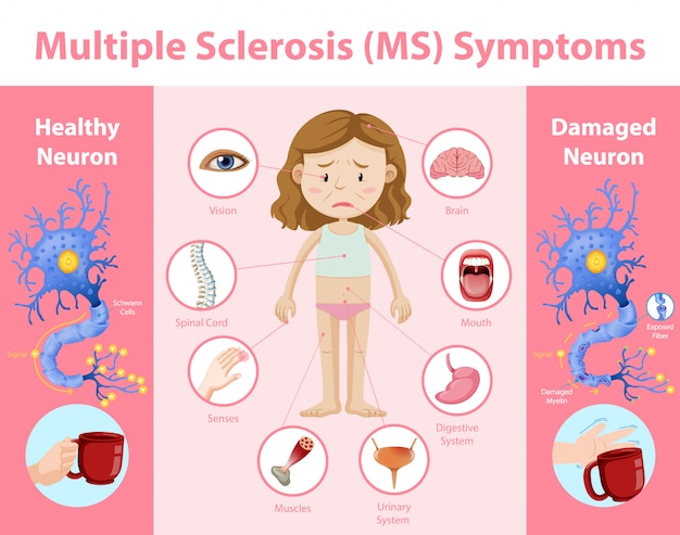 Infográfico de informações de sintomas de esclerose múltipla (em)