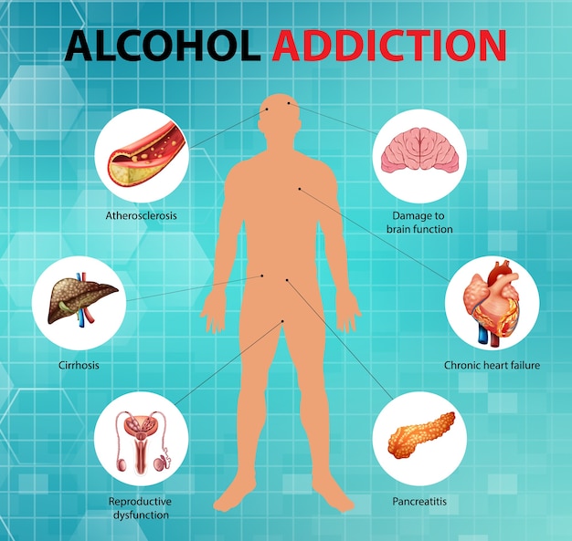 Vetor grátis infográfico de informações sobre dependência de álcool ou alcoolismo