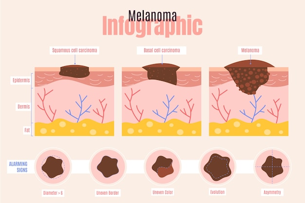 Vetor grátis infográfico de melanoma de design plano desenhado à mão