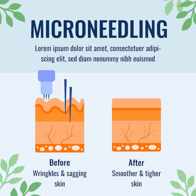 Vetor grátis infográfico de microagulhamento de design plano desenhado à mão