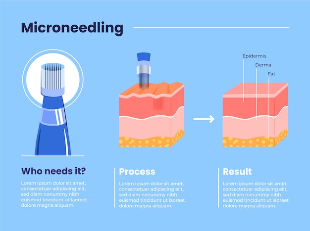 Vetor grátis infográfico de microagulhamento de design plano desenhado à mão