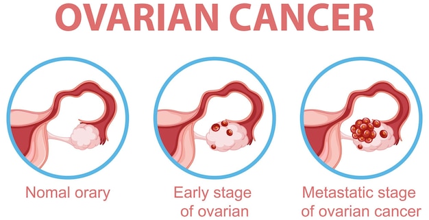 Infográfico de processo de desenvolvimento de câncer de ovário