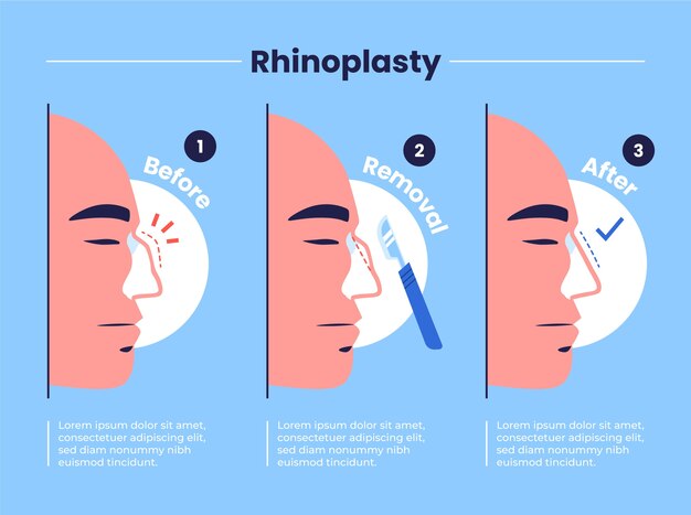 Infográfico de rinoplastia de design plano desenhado à mão