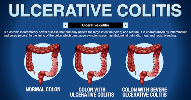 Infográfico de sintomas de colite ulcerosa