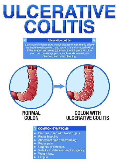 Infográfico de sintomas de colite ulcerosa