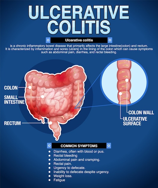 Vetor grátis infográfico de sintomas de colite ulcerosa