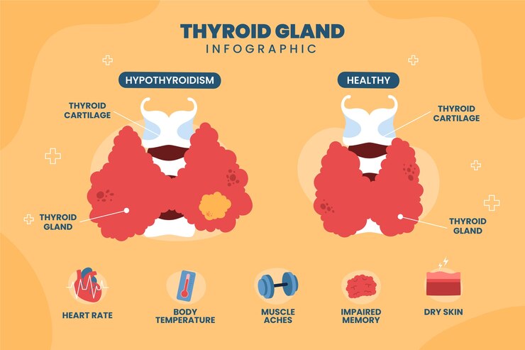 Vetor grátis infográfico de tireóide de design plano desenhado à mão
