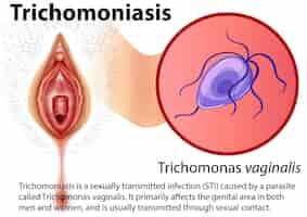 Vetor grátis infográfico de tricomoníase com explicação