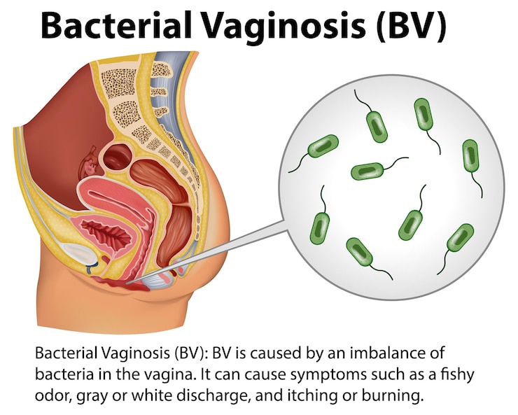 Vetor grátis infográfico de vaginose bacteriana bv com explicação