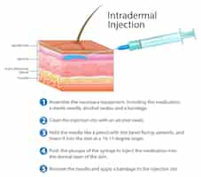 Vetor grátis injeção intradérmica com explicação