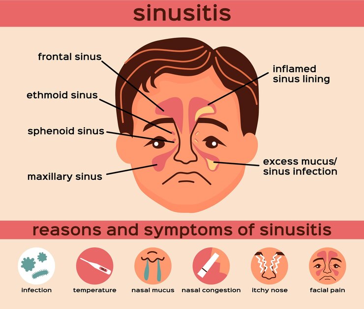 Vetor grátis layout de infográficos planos de doença nasal com razões e sintomas de ilustração vetorial de sinusite