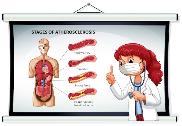 Médico, explicando, fases, de, aterosclerose