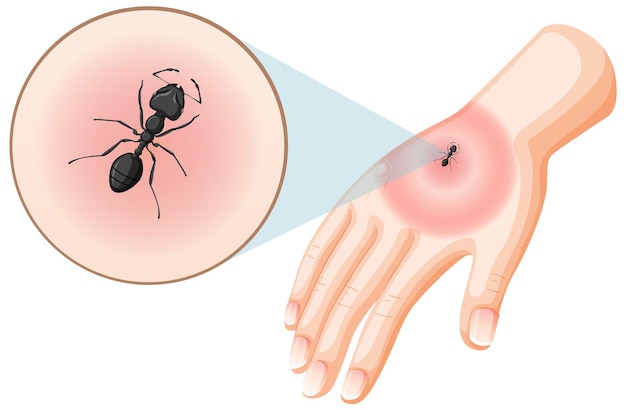 Vetor grátis picadas de formigas pretas picam na pele