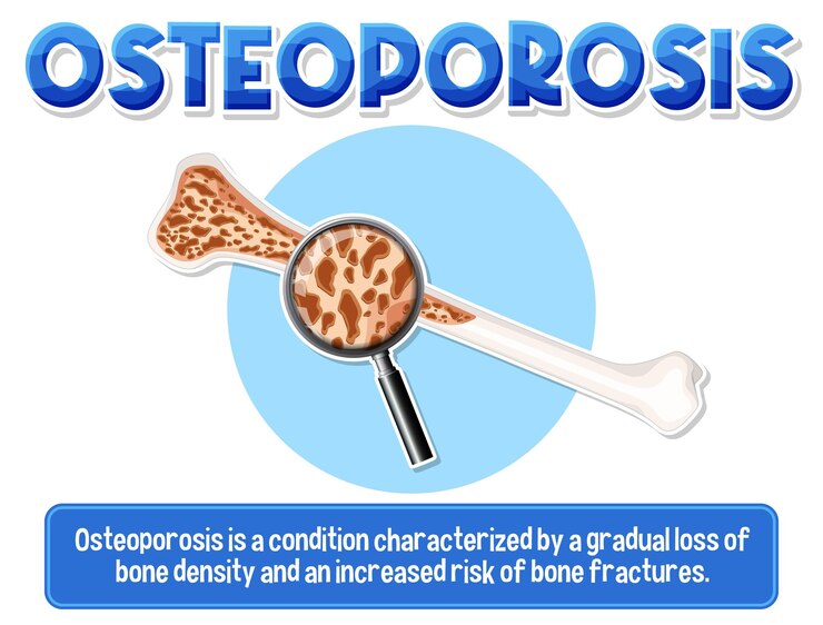 Vetor grátis poster informativo de osteoporose óssea humana