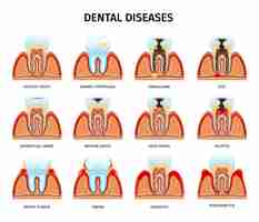 Vetor grátis problemas de anatomia dos dentes definidos com composições isoladas de dente na mandíbula saudável e danificado com ilustração vetorial de texto