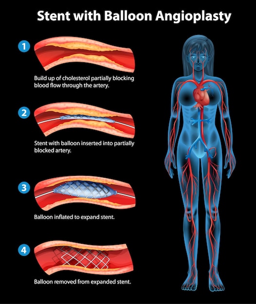 Vetor grátis procedimento de angioplastia com stent