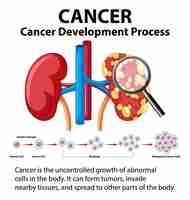 Vetor grátis processo de desenvolvimento do câncer no rim humano um infográfico