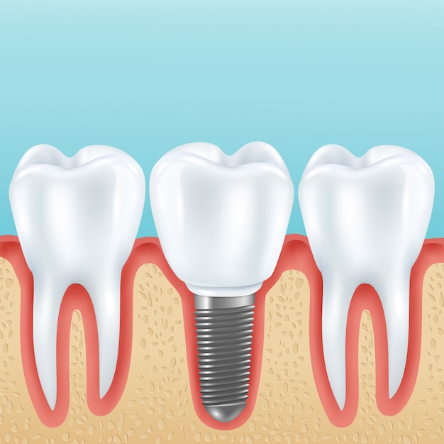 Vetor grátis próteses dentárias com dentes saudáveis