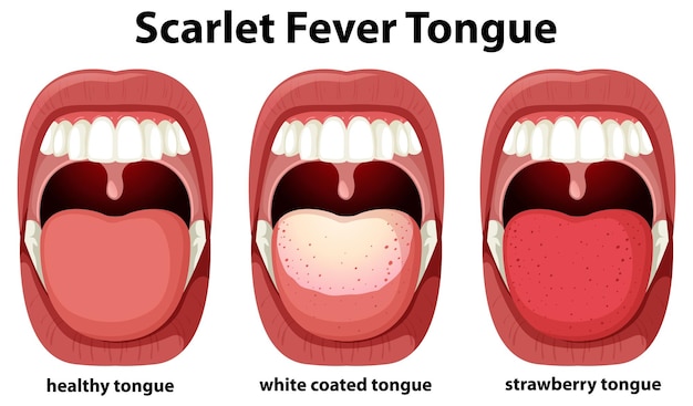 Vetor grátis sintomas da língua da escarlatina