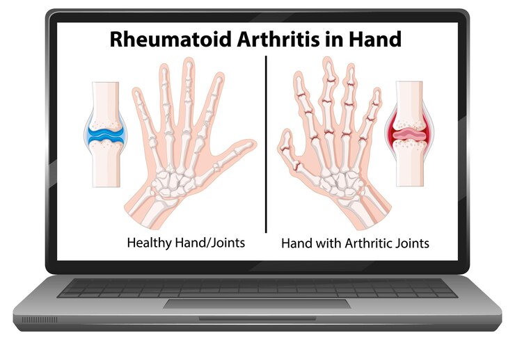 Vetor grátis sintomas de artrite reumatóide disponíveis na tela do laptop