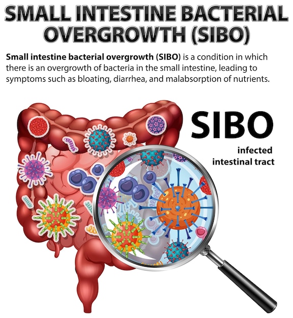 Vetor grátis supercrescimento bacteriano do intestino delgado sibo