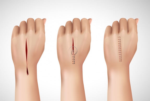 Vetor grátis sutura cirúrgica costura composição realista com imagens isoladas de mão humana em diferentes estágios da costura