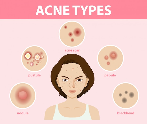 Vetor grátis tipos de acne na pele ou espinhas