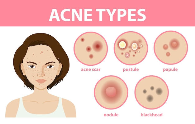 Vetor grátis tipos de acne na pele ou espinhas