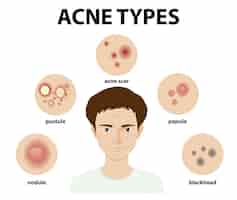 Vetor grátis tipos de acne na pele ou espinhas