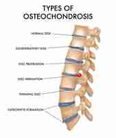 Vetor grátis tipos de osteocondrose com coluna vertebral