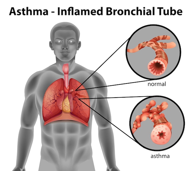 Um tubo brônquico inflamado pela asma