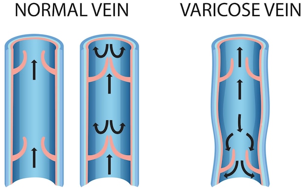 Uma comparação de veia normal com veia varicosa