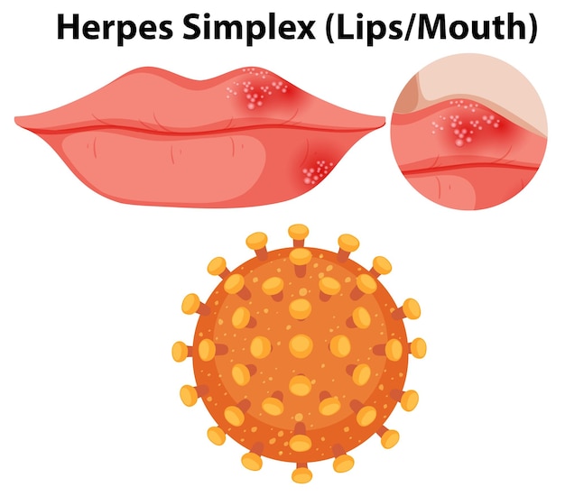 Vetor grátis vírus herpes simplex lipsmouth