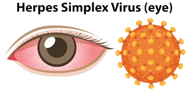 Vetor grátis vírus herpes simplex olho