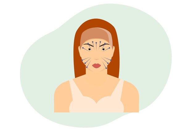 3852 Ilustração do conceito de acupuntura facial