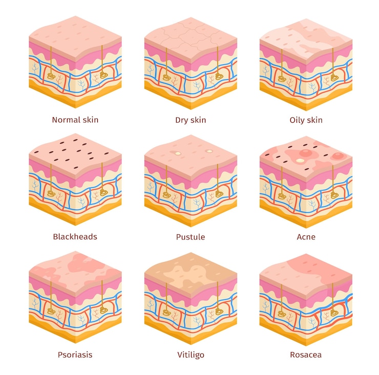 Vetor 3d tipos de pele humana camadas de seção transversal epiderme oleosa e normal seca problemas de pele acne cravos psoríase e vitiligo conjunto vetorial ilustração de epiderme médica dermatologia