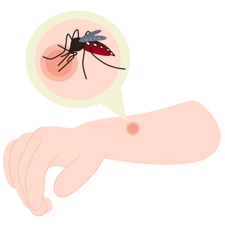 Vetor a mão humana com a picada de mosquito mão de picada de mosquito picada de mosquito ilustração em saúde